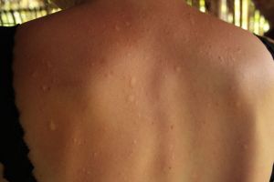 K's welts from the stinging nettles