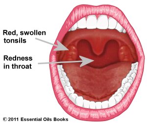 Trust me, this is as close as you want to get to images of tonsiloliths.